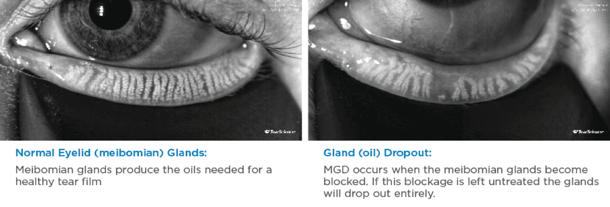 Normal and blocked Meibomian glands side by side